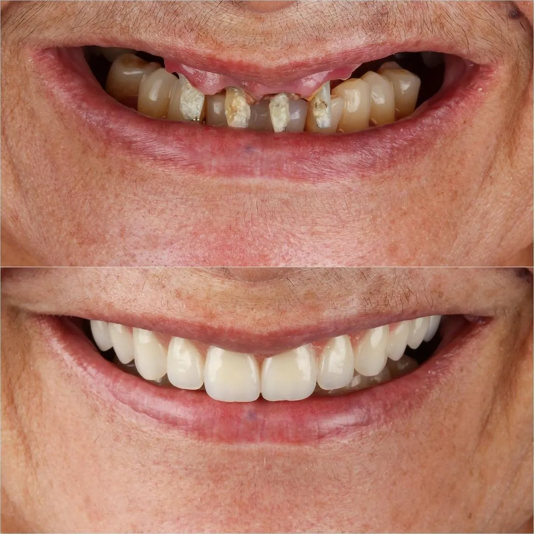 Dental Implant