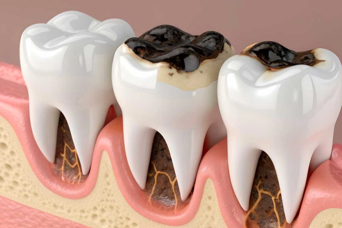  What is Root Tooth Decay?