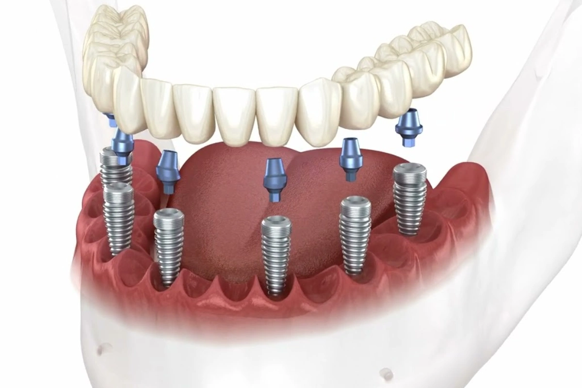 All-on-6 Dental Implants