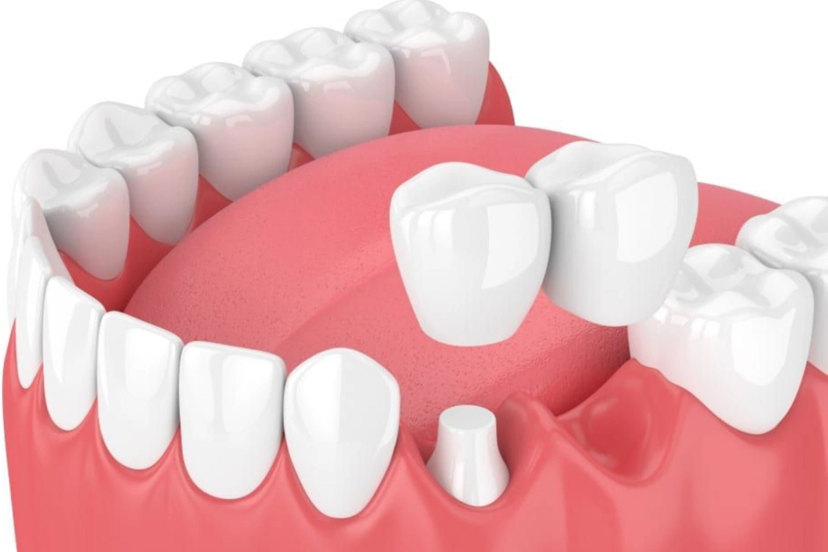 Dental Bridge